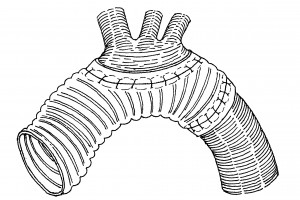 aortic regurgitation Аортальная регургитация