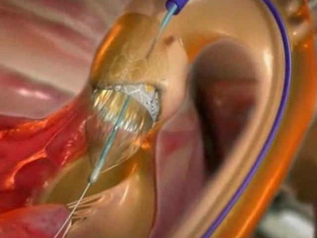 aortic valve Аортальный клапан