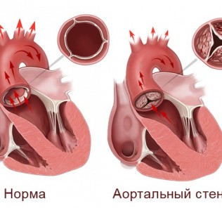 congenital anomalies of the aortic valve Врожденные аномалии аортального клапана