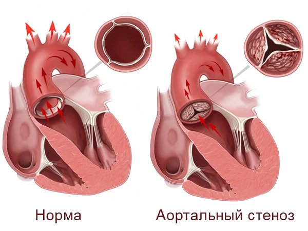 congenital anomalies of the aortic valve Врожденные аномалии аортального клапана