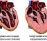echocardiographic signs Эхокардиографические признаки