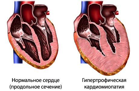 echocardiographic signs Эхокардиографические признаки