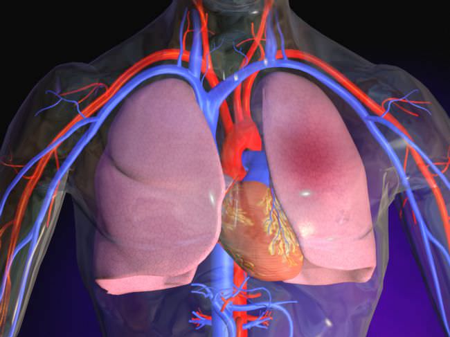 embolic heart and endocardium Эмболические сердца и эндокарде