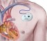 intracardiac device Внутрисердечные устройства