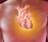 malignant tumors of the heart Злокачественные опухоли сердца