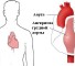 pathology of the aorta Патология аорты