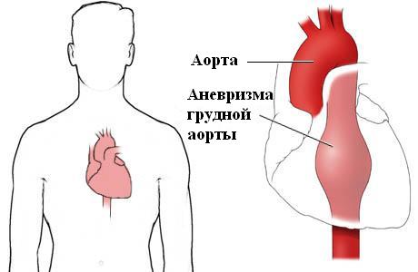 pathology of the aorta Патология аорты