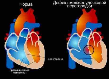 the atrial septal defects Дефекты межпредсердной перегородки
