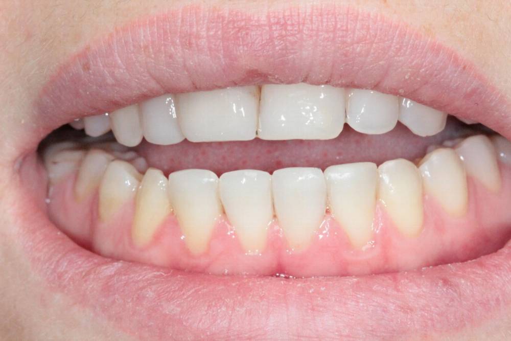 безболезненное-лечение-зубов-в-79