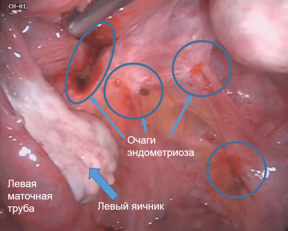 эндометриоза на связках матки Ультразвуковая картина неизмененных яичников