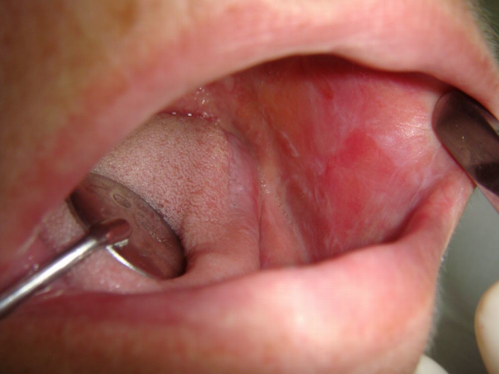 . 1 типичная форма КПЛ Заболевание ладоней, подошв и слизистой рта