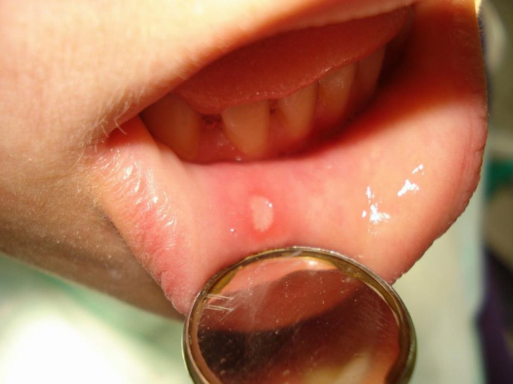 стоматит на внутренней поверхности нижней губы Афтозный стоматит