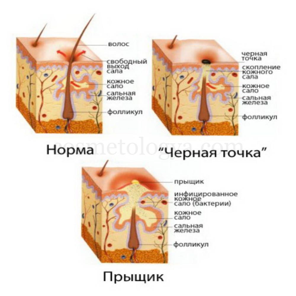 Что значит прыщ. Подкожный прыщ строение.