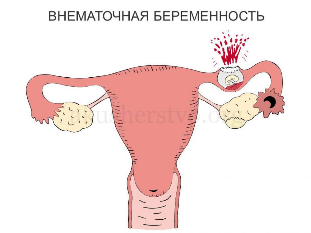 ectopic beremennost2 Внематочная беременность