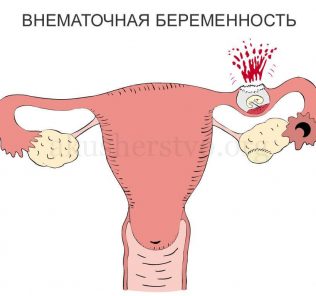 ectopic beremennost2 Внематочная беременность