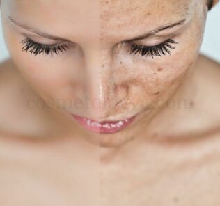 lechenie giperpigmentacii Как отбелить кожу народными способами