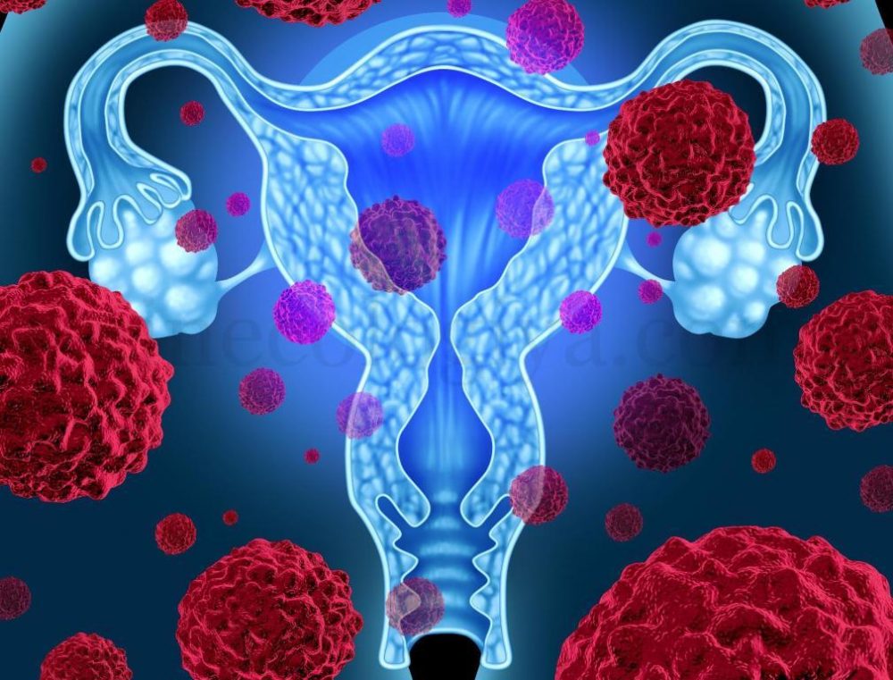 ovariancancer Рак яичников. Симптомы ранней и запущенной стадии