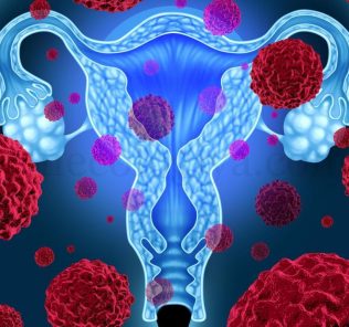 ovariancancer Рак яичников. Симптомы ранней и запущенной стадии