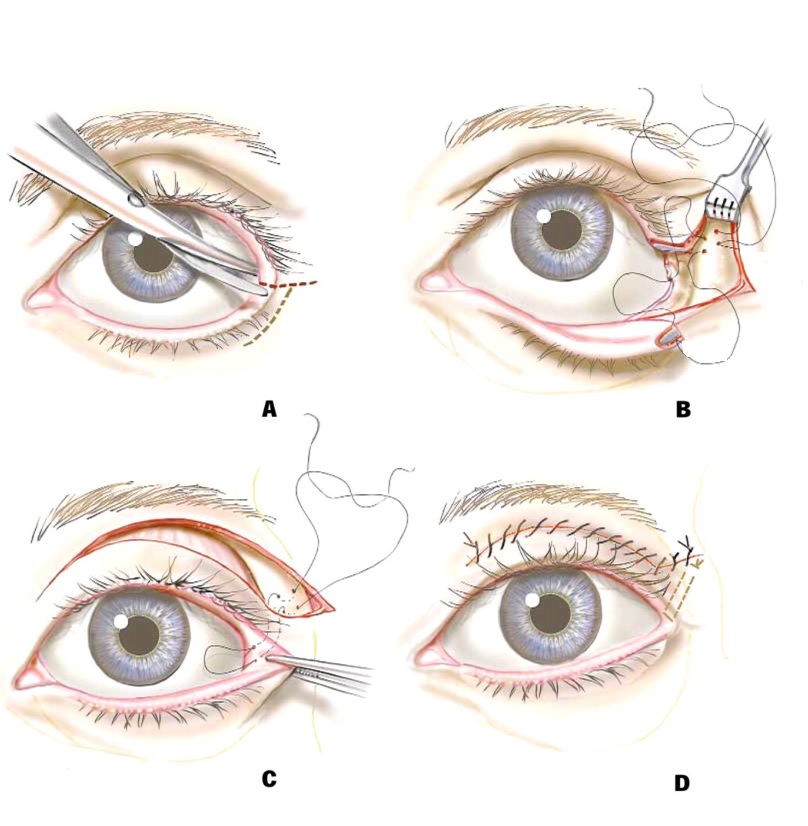 tehnika lateralnoj kantoplastiki Кантопластика - изменение формы глаз